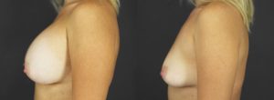 Implant Explantation Before and After Patient 1 - Profile View