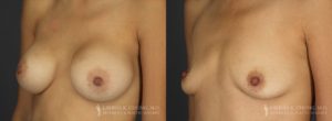 Implant Explantation Before and After Patient 4 - Angled View