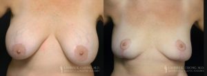 Implant Explantation Before and After Patient 5 - Front View - B