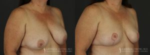 Implant Explantation Before and After Patient 6 - Angled View