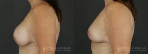 Implant Explantation Before and After Patient 6 - Profile View