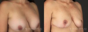 Implant Explantation Before and After Patient 7 - Angled View