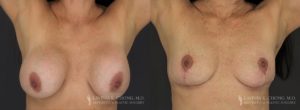 Implant Explantation Before and After Patient 7 - Front View