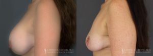 Implant Explantation Before and After Patient 7 - Profile View