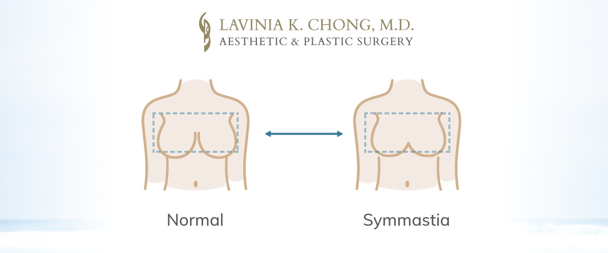 Diagram of symmastia