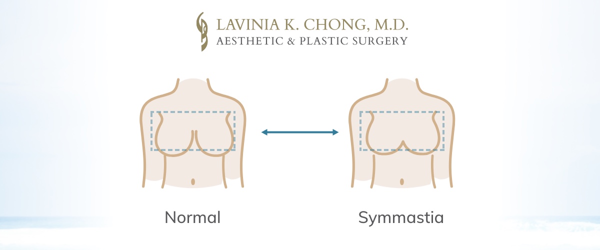 Diagram of symmastia | lavinia k chong m D