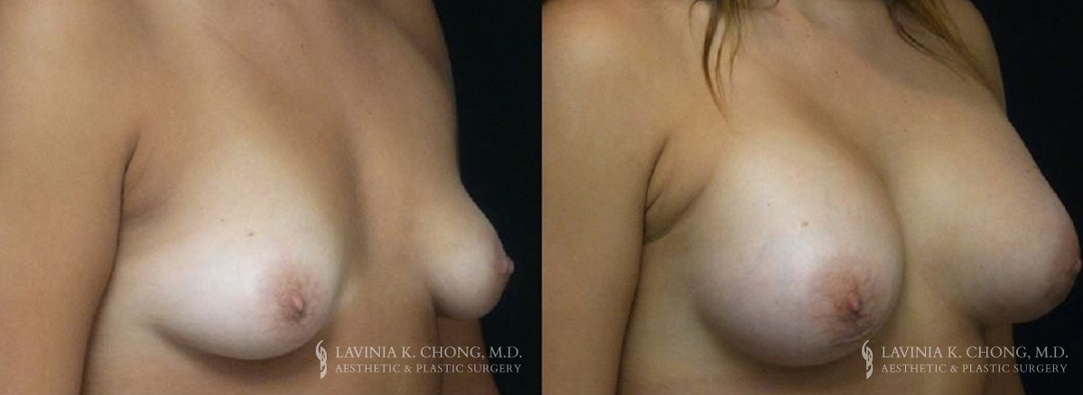 Patient 10.2 Before and After Breast Augmentation
