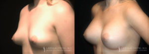 Patient 5.3 Before and After Breast Augmentation