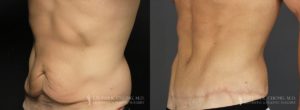 Abdominoplasty for Men Before & After Patient 1 - Angled View