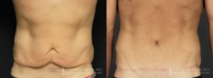 Abdominoplasty for Men Before & After Patient 1 - Front View