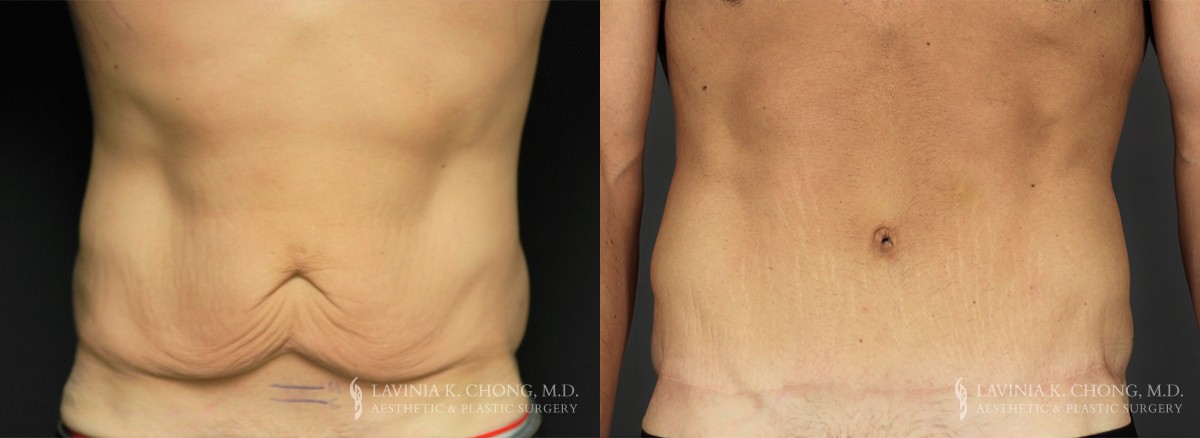 Abdominoplasty Tummy Tuck Surgery With Guy Sterne