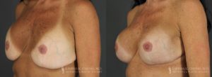 Strattice Before & After Patient 1 - Angled View