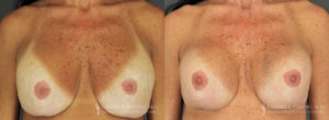 Strattice Before & After Patient 1 - Front View