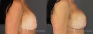 Strattice Before & After Patient 1 - Side View