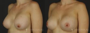 Strattice Before & After Patient 2 - Angled View