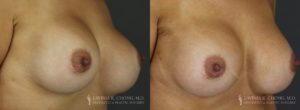 Strattice Before & After Patient 3 - Angled View