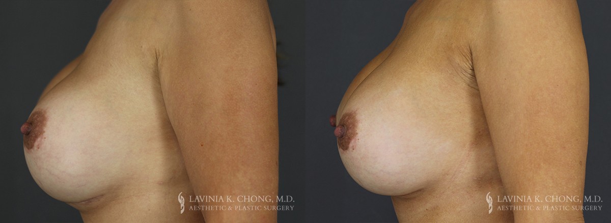 Strattice Before & After Patient 3 - Side View