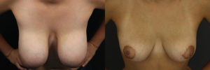 Breast Reduction 6432 B&A A