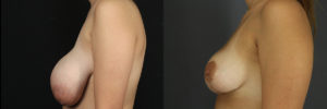 Breast Reduction 6432 B&A B