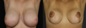 Breast Reduction 6432 B&A C