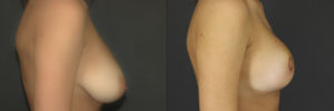 Patient 1.1 Before & After Breast Reduction