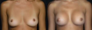 Patient 1.1 Before and After Breast Augmentation