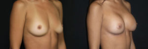 Patient 1.2 Before and After Breast Augmentation