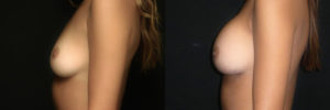 Patient 1.3 Before and After Breast Augmentation
