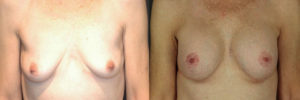 Patient 11.1 Before and After Breast Augmentation