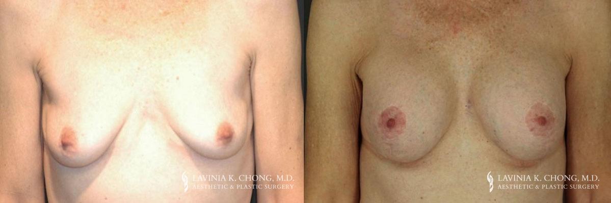 Patient 11.1 Before and After Breast Augmentation