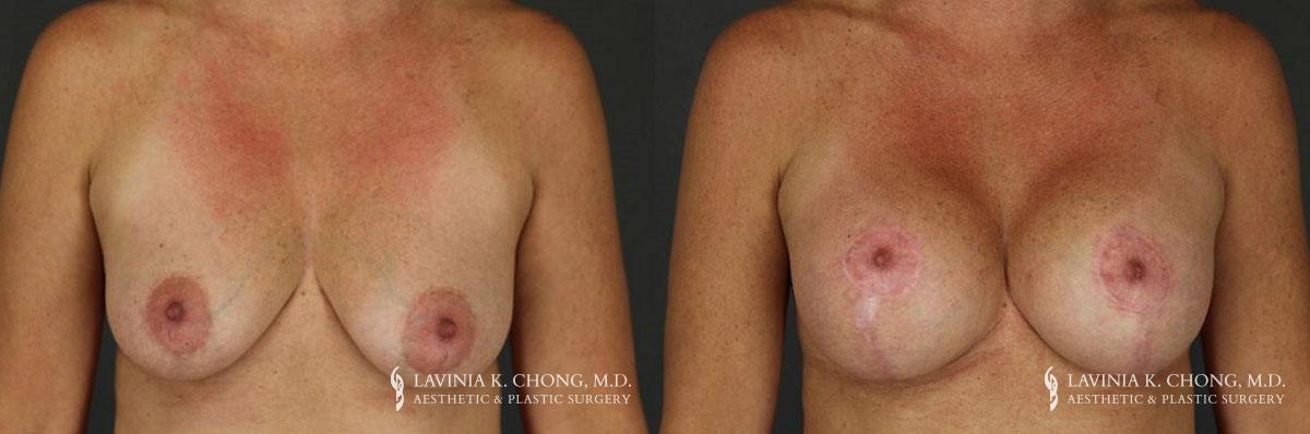 Patient 12.1 Before and After Breast Augmentation