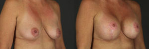 Patient 12.2 Before and After Breast Augmentation