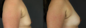 Patient 13.1 Before and After Breast Augmentation
