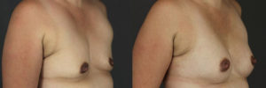 Patient 13.2 Before and After Breast Augmentation