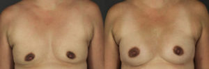 Patient 13.3 Before and After Breast Augmentation