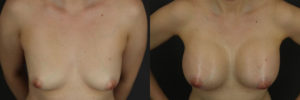 dr-chong-newport-beach-breast-augmentation-patient-13-1-1