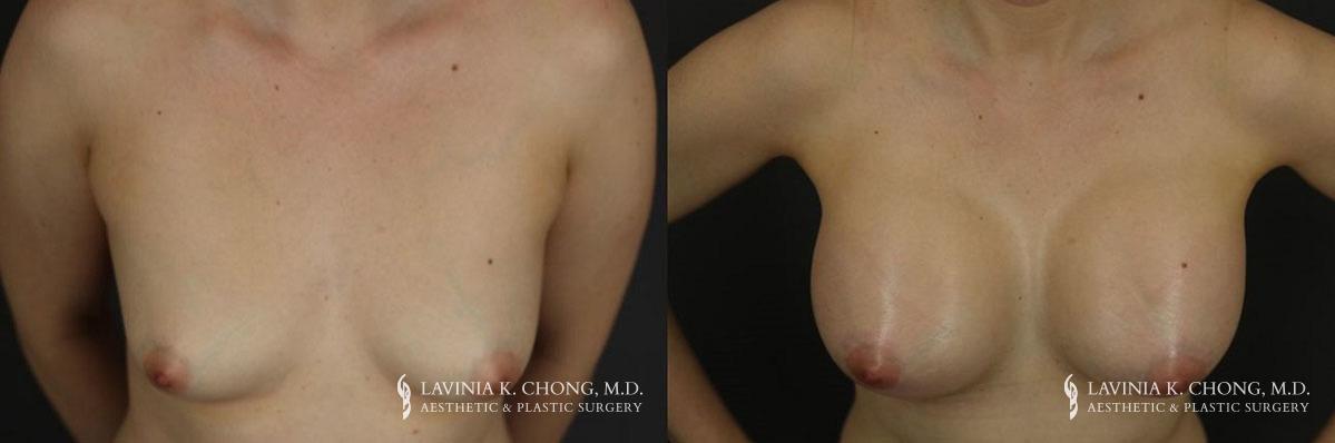 dr-chong-newport-beach-breast-augmentation-patient-13-1-1