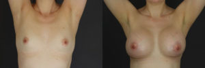 Patient 14.2 Before and After Breast Augmentation