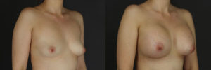 Patient 14.3 Before and After Breast Augmentation