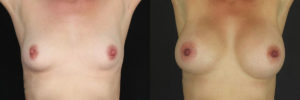 Patient 15.1 Before and After Breast Augmentation