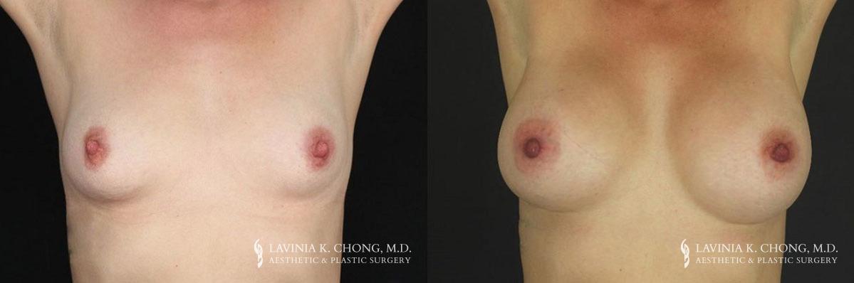 Patient 15.1 Before and After Breast Augmentation