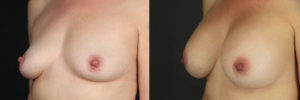 Patient 15.2 Before and After Breast Augmentation