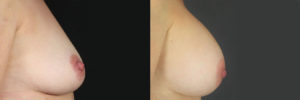 Patient 15.3 Before and After Breast Augmentation