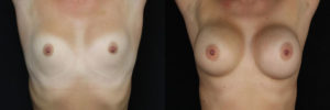 Patient 16.1 Before and After Breast Augmentation