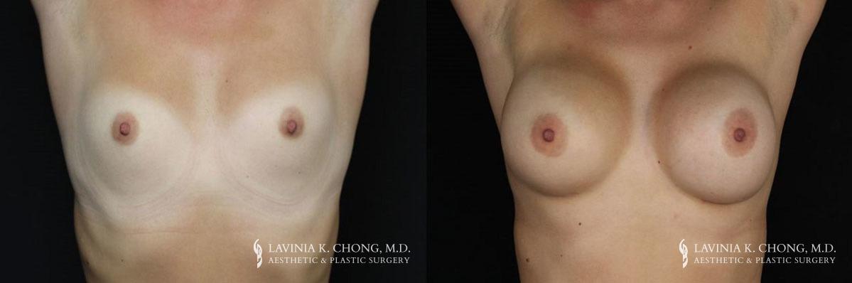 Patient 16.1 Before and After Breast Augmentation