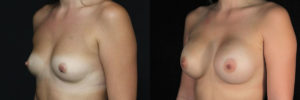 Patient 16.2 Before and After Breast Augmentation