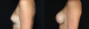 Patient 16.3 Before and After Breast Augmentation