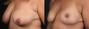 Patient 2.1 Before & After Breast Reduction