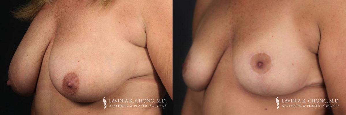 Patient 2.1 Before & After Breast Reduction