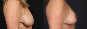 Patient 2.2 Before & After Breast Reduction